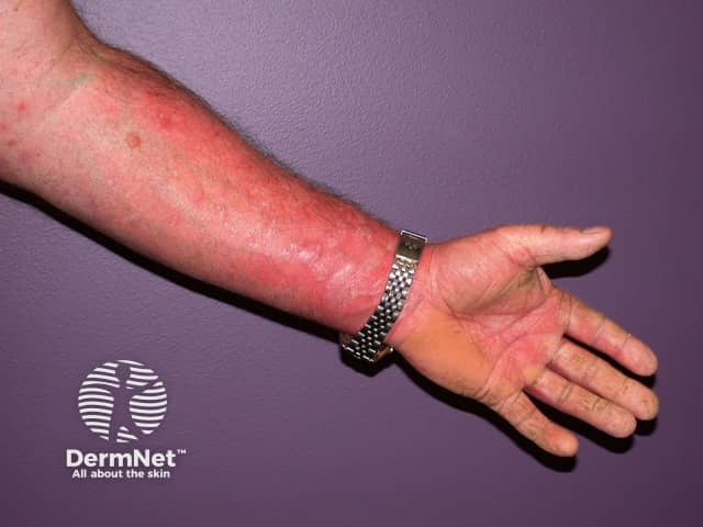 Contact allergic dermatitis of the arms and legs