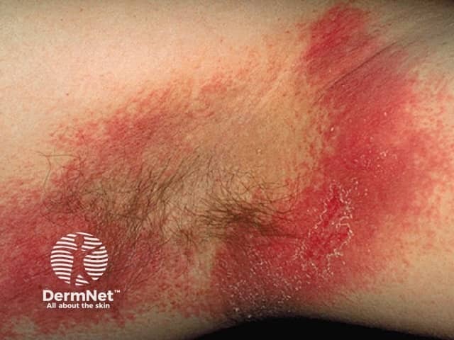 Contact allergic dermatitis of the arms and legs