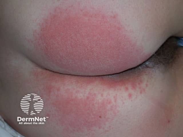 Contact allergic dermatitis of the arms and legs