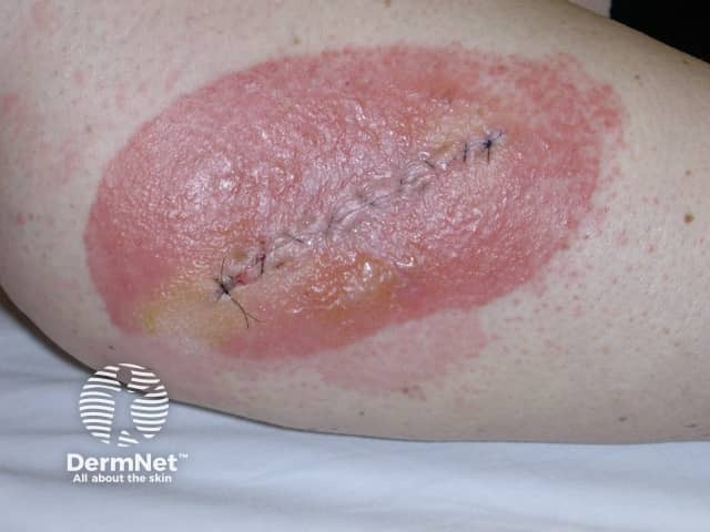 Contact allergic dermatitis of the arms and legs