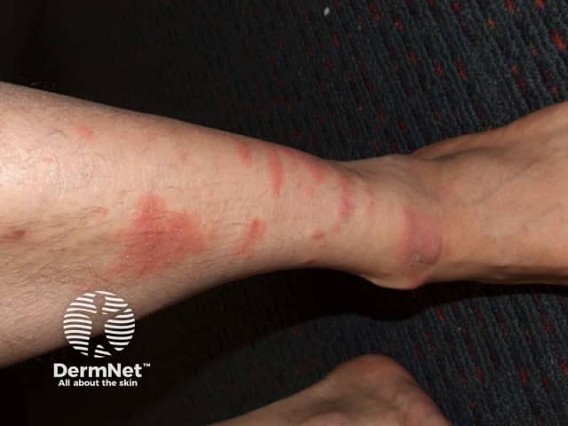 Contact allergic dermatitis of the arms and legs