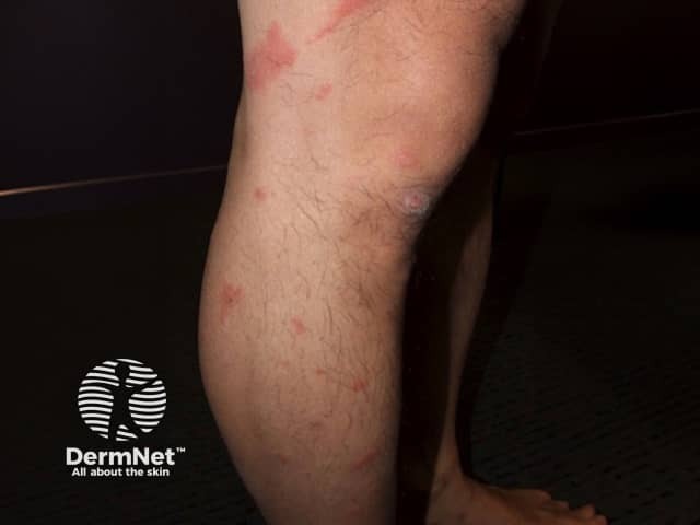 Contact allergic dermatitis of the arms and legs