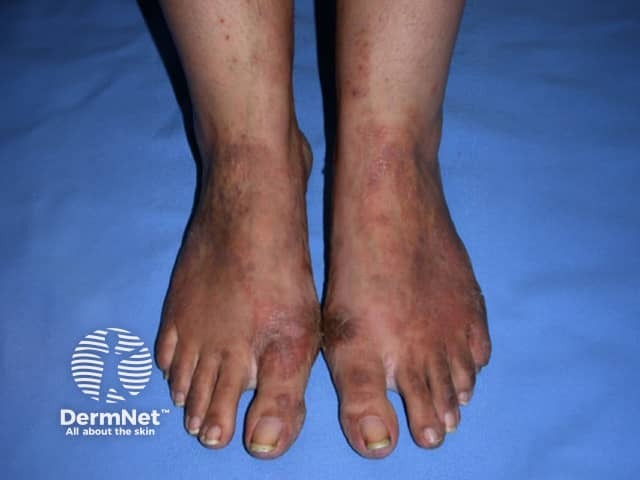 Contact allergic dermatitis of the arms and legs