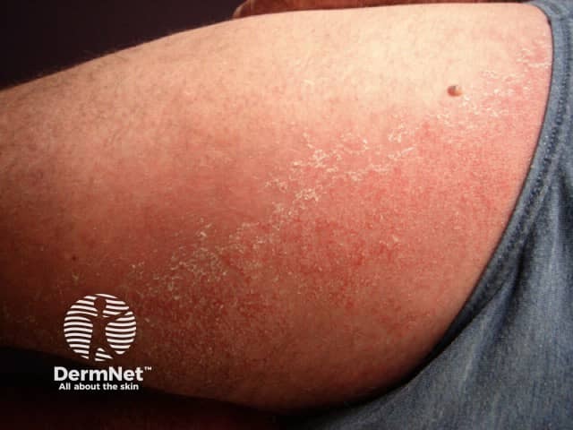 Contact allergic dermatitis of the arms and legs