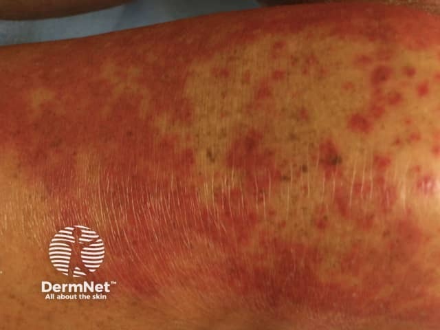 Contact allergic dermatitis of the arms and legs