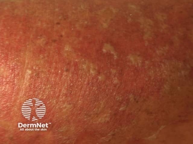 Contact allergic dermatitis of the arms and legs