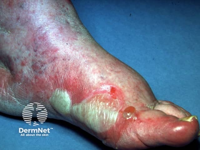 Contact allergic dermatitis of the arms and legs