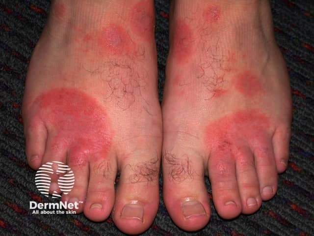 Contact allergic dermatitis of the arms and legs