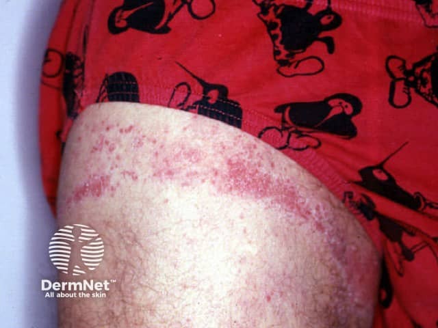 Rubber dermatitis