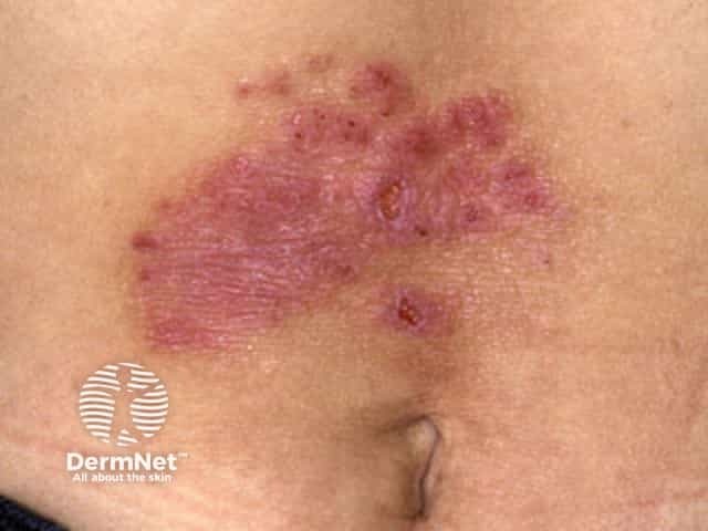 Contact allergic dermatitis of the torso