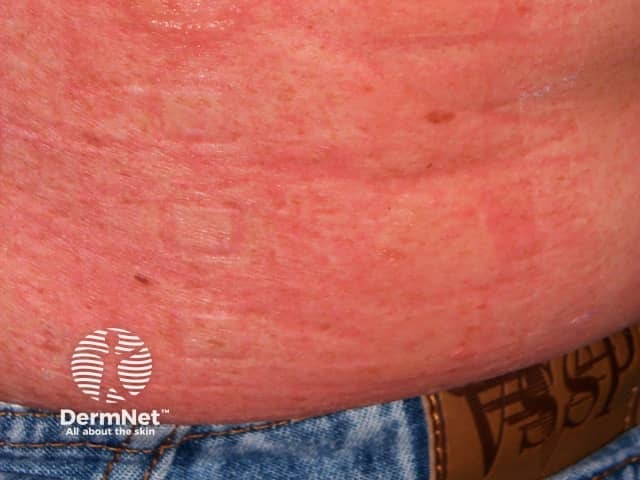 Contact allergic dermatitis of the torso