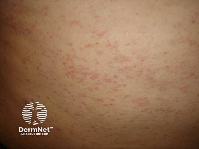 Contact allergic dermatitis of the torso