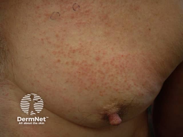 Contact allergic dermatitis of the torso