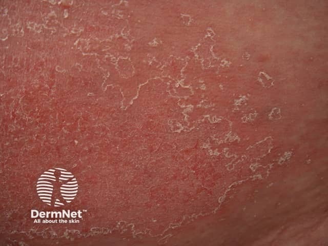 Contact allergic dermatitis of the torso