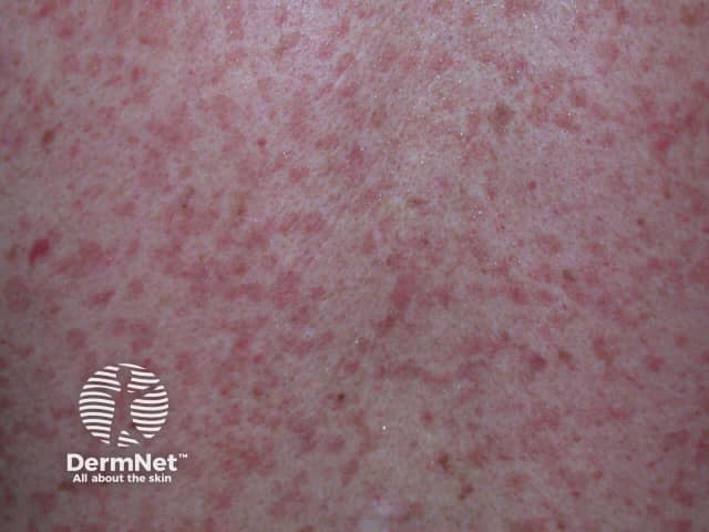 Contact allergic dermatitis of the torso