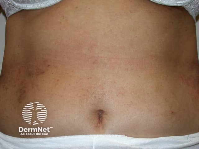 Contact allergic dermatitis of the torso