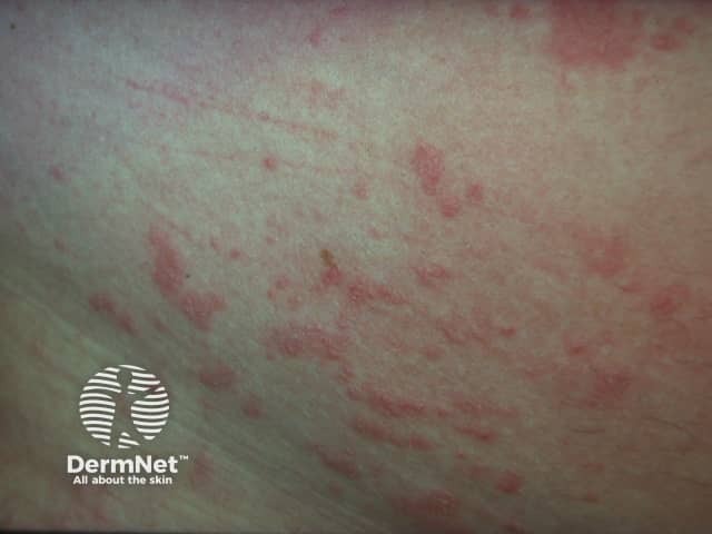 Contact allergic dermatitis of the torso