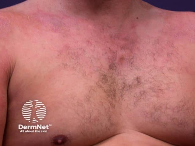 Contact allergic dermatitis of the torso