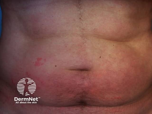 Contact allergic dermatitis of the torso