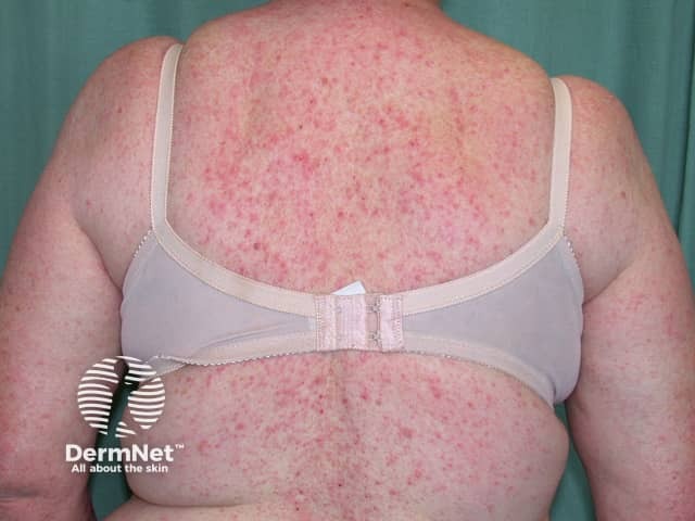 Contact allergic dermatitis of the torso