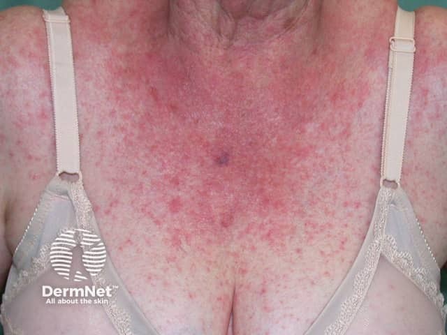 Contact allergic dermatitis of the torso