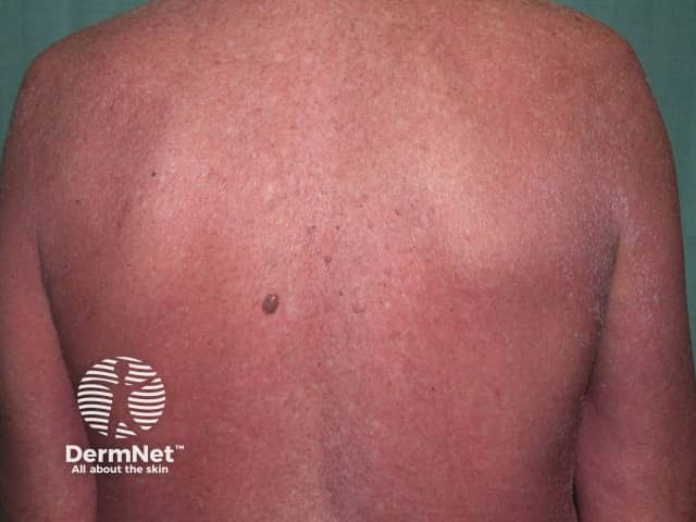 Contact allergic dermatitis of the torso