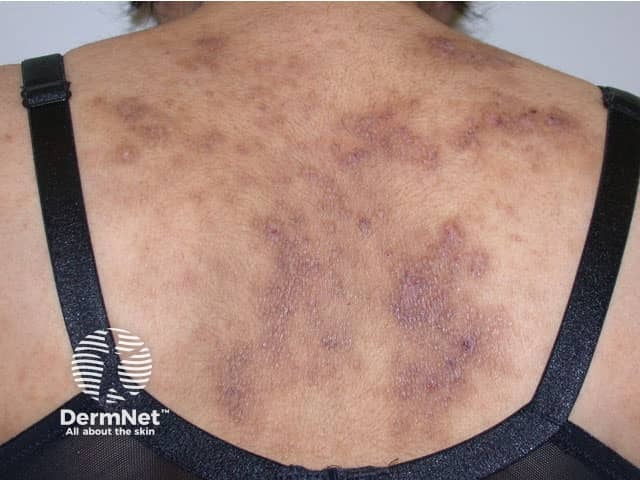 Atopic eczema