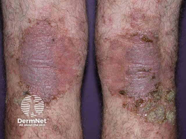 Infected dermatitis