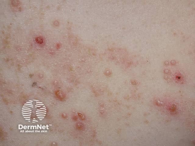 Molluscum contagiosum arising in atopic dermatitis