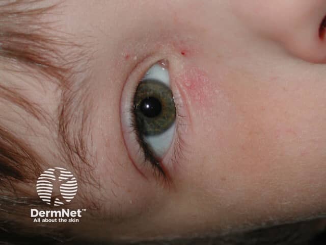 Eyelid contact dermatitis