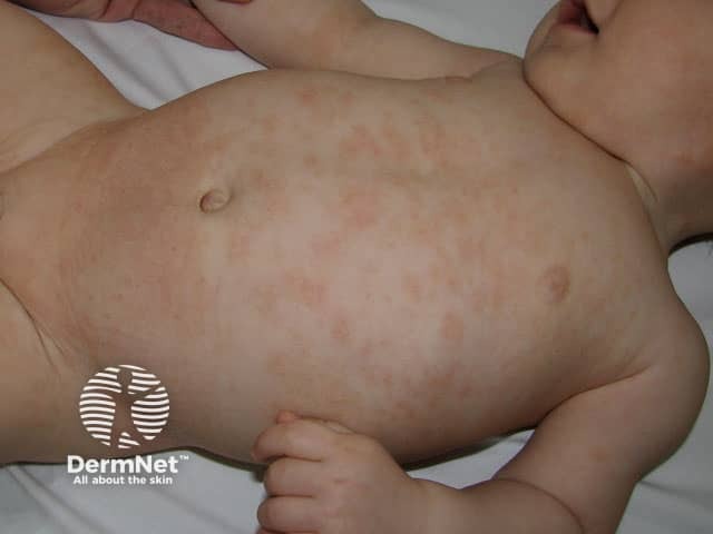 Infantile atopic dermatitis, trunk