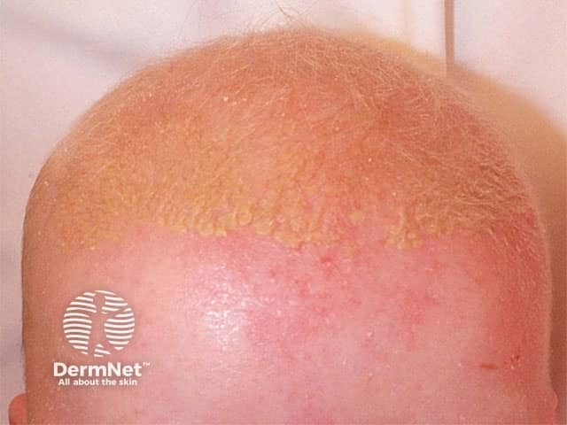 Seborrhoeic dermatitis