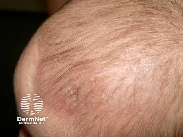 Cradle cap