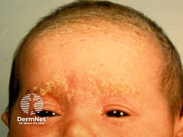 Cradle cap