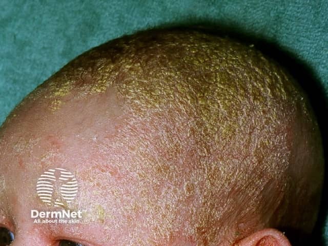 Cradle cap