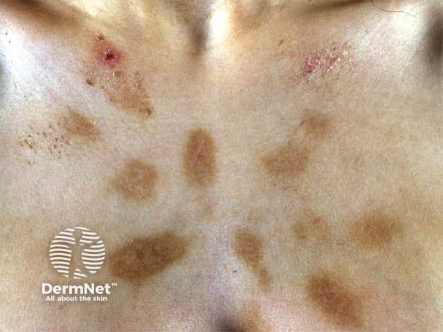 Dermatitis artefacta