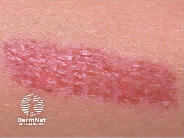 Dermatitis artefacta