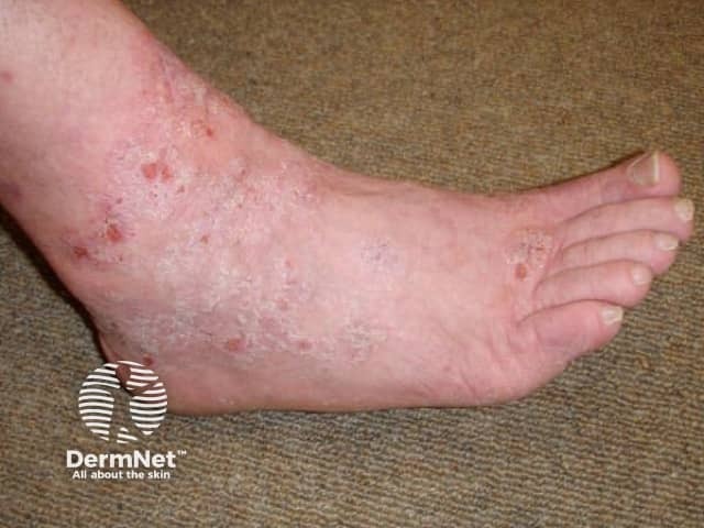 Contact dermatitis due to neoprene and diethylthiourea allergy