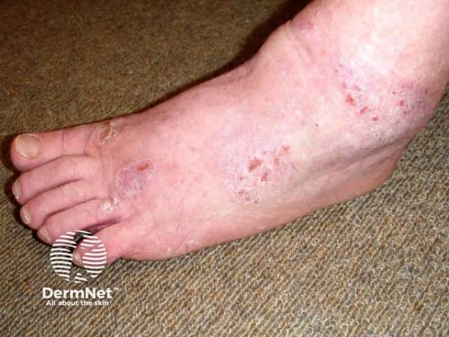 Contact dermatitis due to neoprene and diethylthiourea allergy