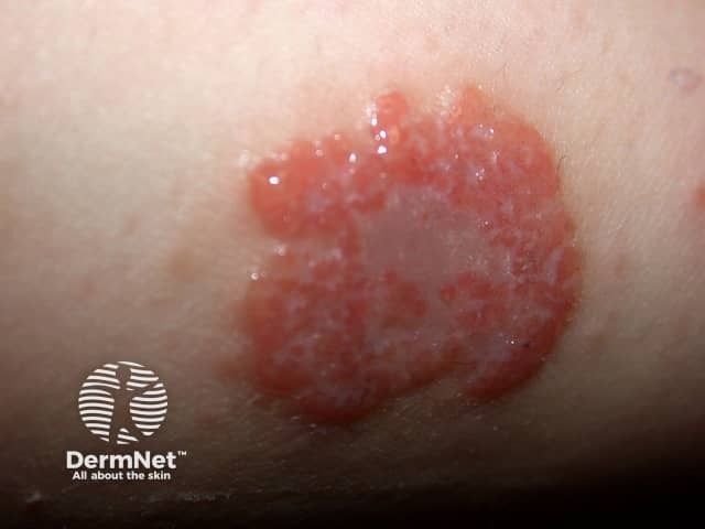 Discoid eczema