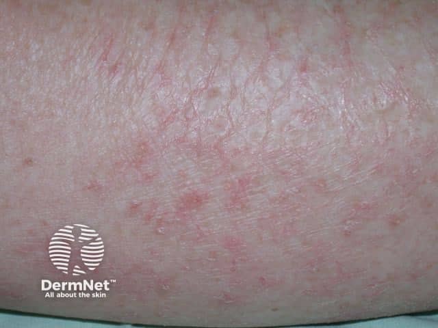 Eczema craquelé