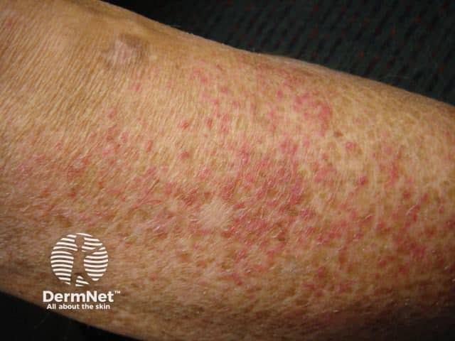 Eczema craquelé