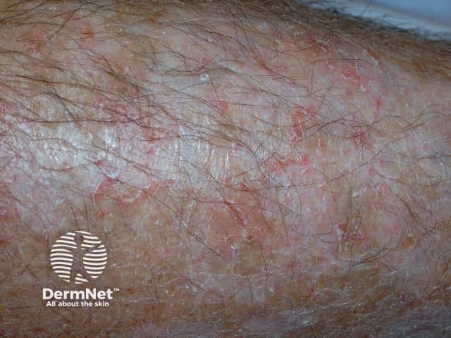 Eczema craquelé