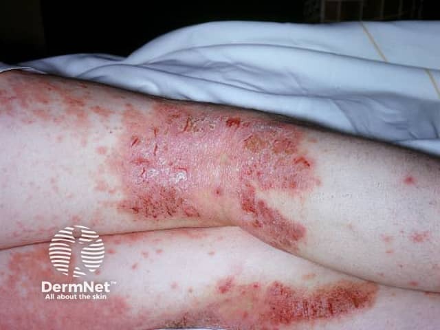 Atopic dermatitis