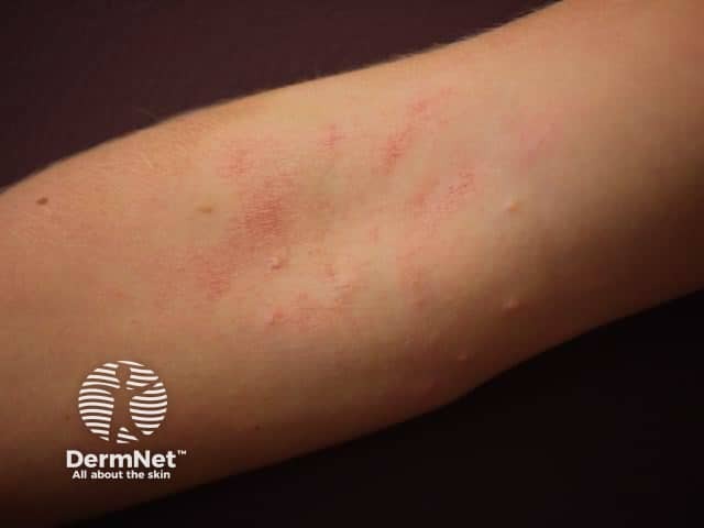 Atopic dermatitis