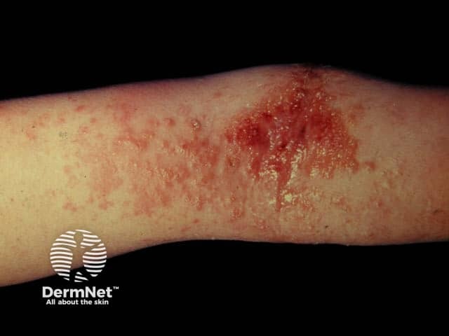 Atopic dermatitis