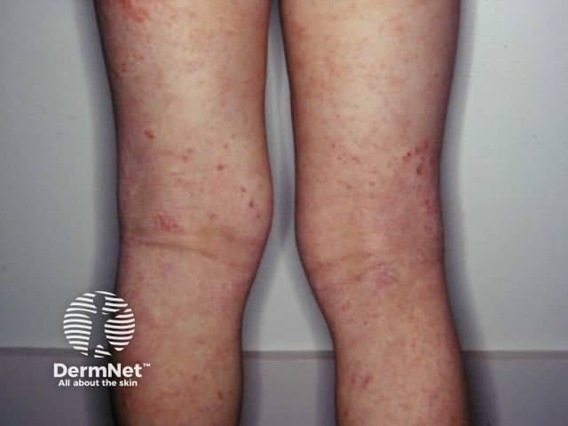 Atopic dermatitis