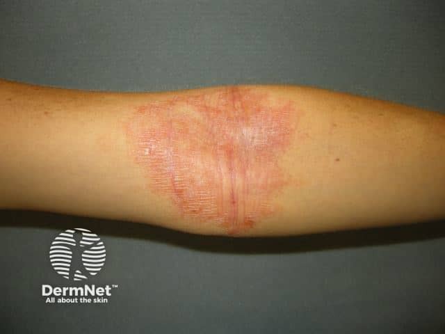 Atopic dermatitis