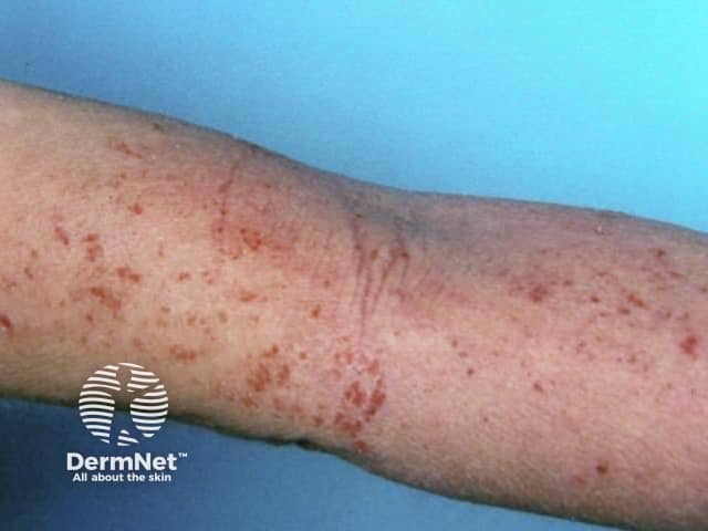 Atopic dermatitis