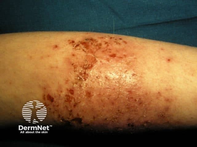 Atopic dermatitis